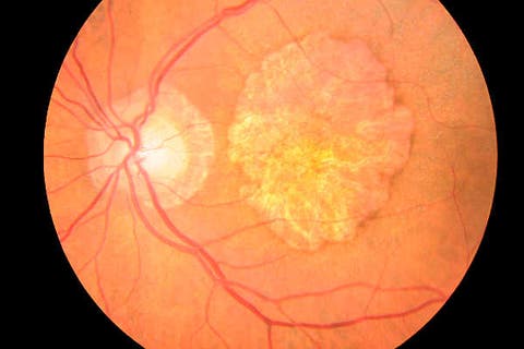 Fotografía ampliada de un globo ocular afectado por Degeneración Macular asociada a la Edad